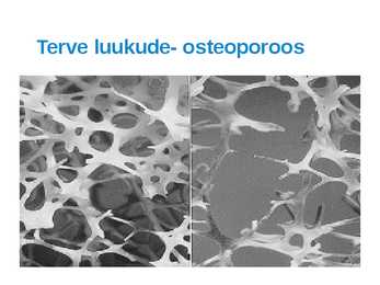 Osteoporoos #9