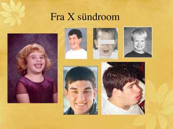 Fragiilne X sündroom #25