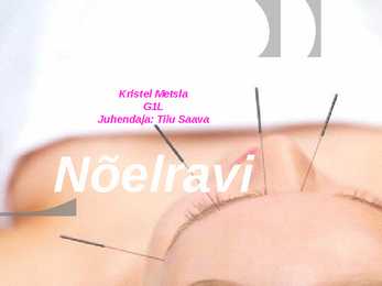 Nõelravi