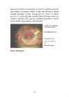 Diabeetiline retinopaatia #16