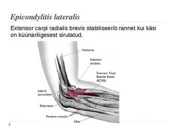 Epicondylitis lateralis #2