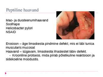 Peptilise haavandi tüsistused #2