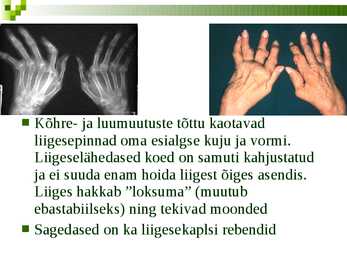 Reumaoidartriit #6