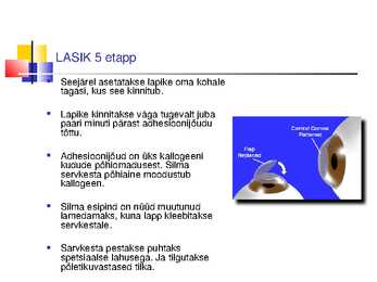 Laserite kasutamine silmakirurgias #22
